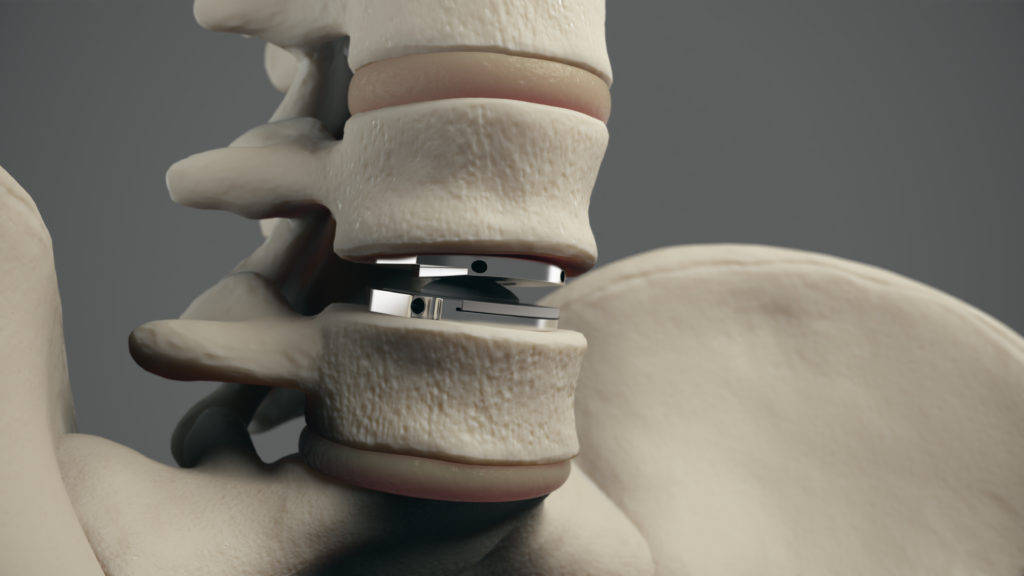 Clinical Outcomes Following Single Level Lumbar Total Disc Replacement